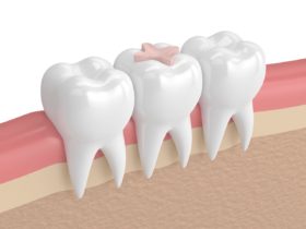 奥歯の治療にはセラミックと銀歯どっちがいいの？ジルコニアが最適な理由も解説