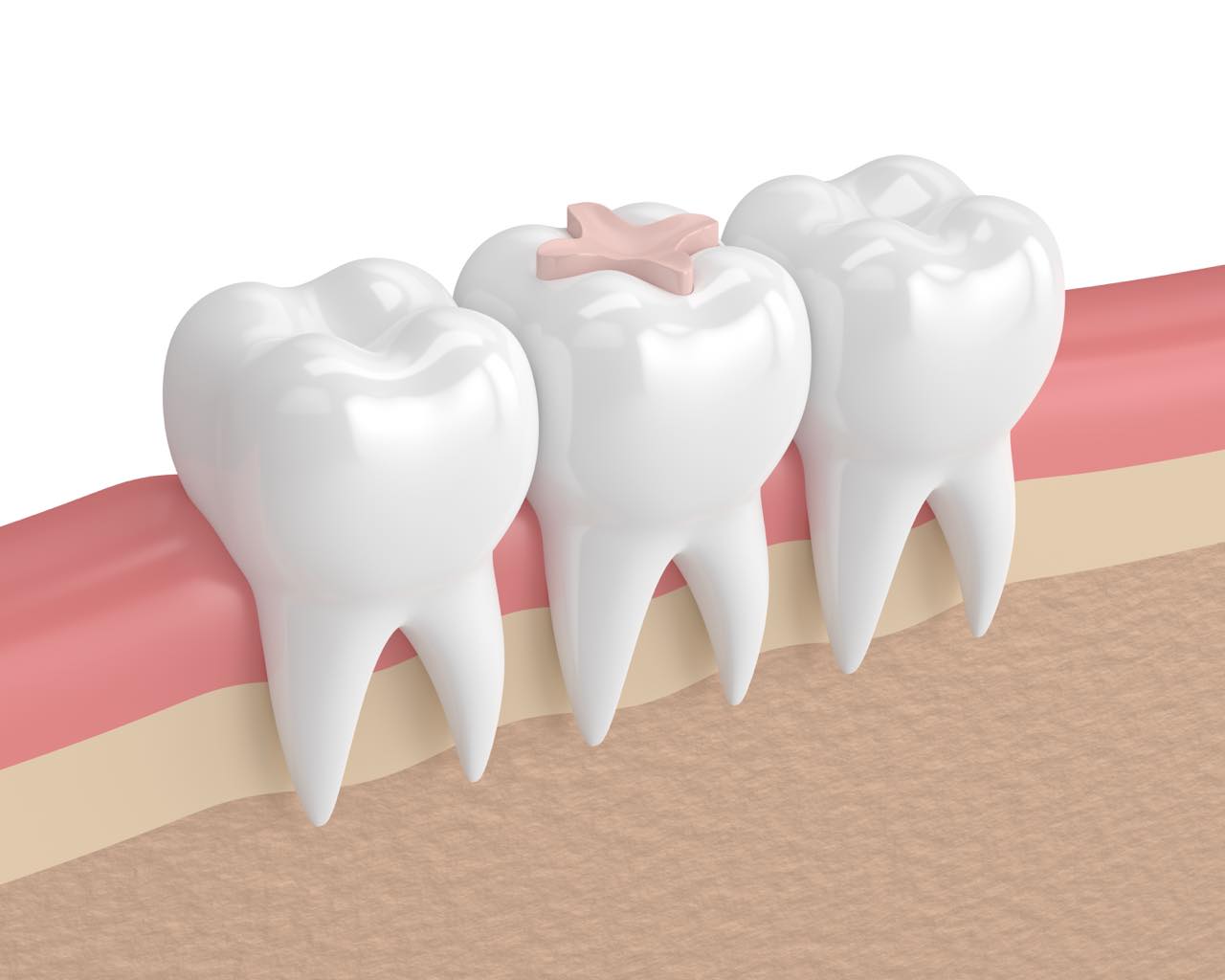 奥歯の治療にはセラミックと銀歯どっちがいいの？ジルコニアが最適な理由も解説