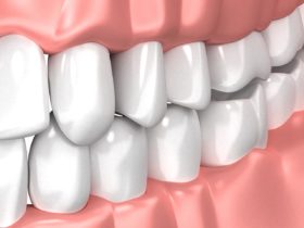 歯ぎしり・食いしばりの理由と対策(治療)は？体に与える影響も解説