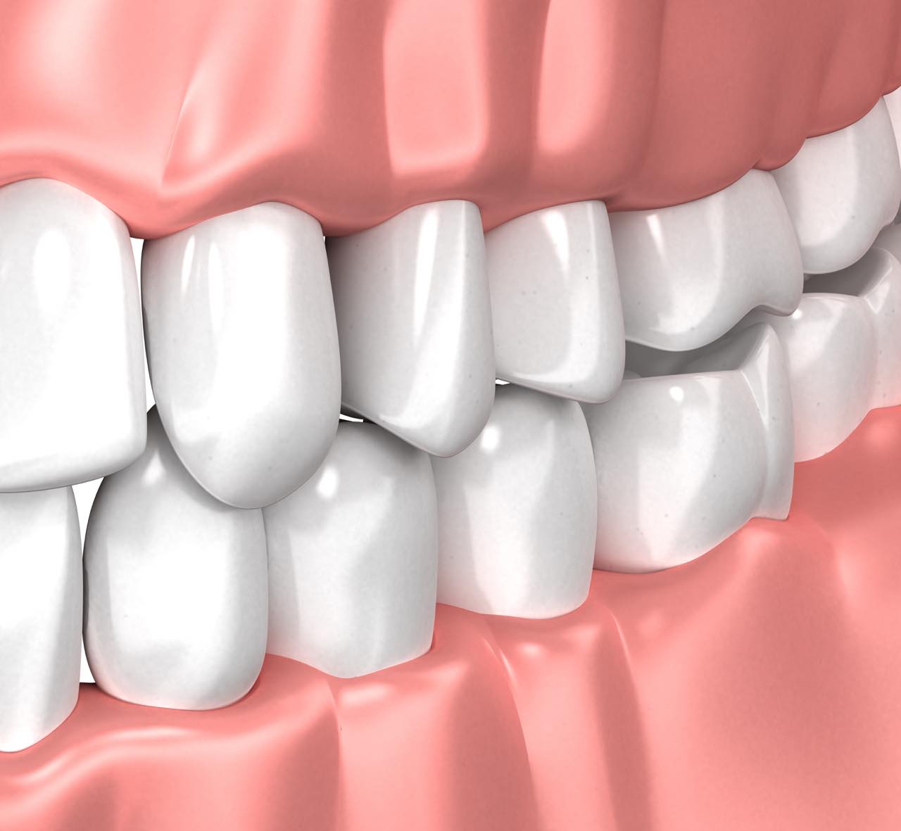 歯ぎしり・食いしばりの理由と対策(治療)は？体に与える影響も解説