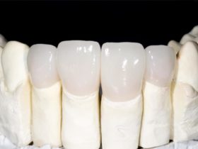 セラミック矯正をした歯の虫歯リスクと対策