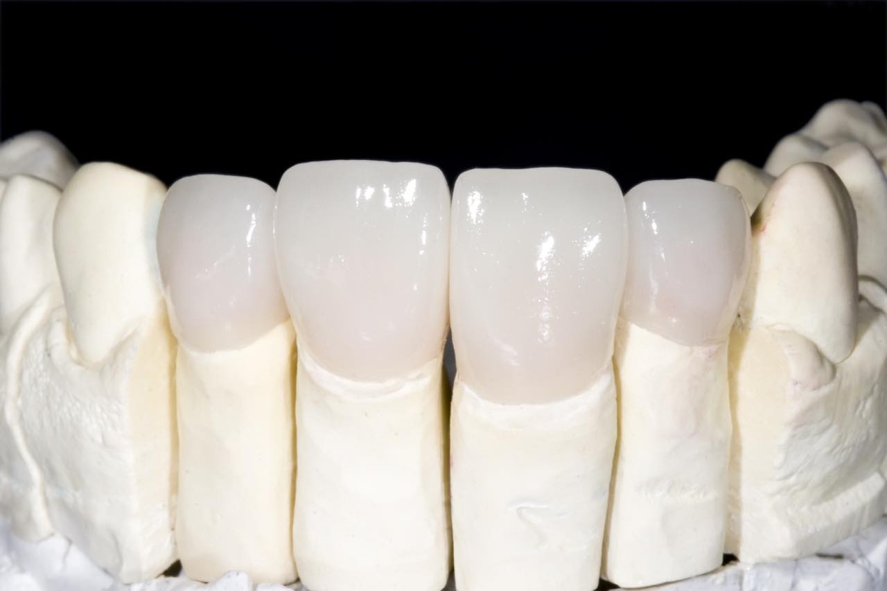セラミック矯正をした歯の虫歯リスクと対策