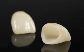差し歯で歯茎が黒い原因と治療法