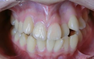 八重歯はセラミック矯正で治せるの？