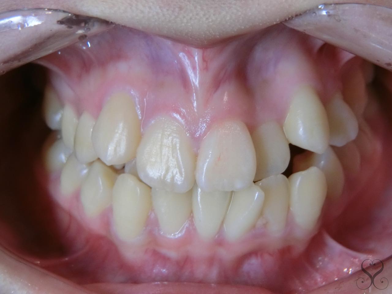 八重歯で乱杭歯状態の歯並びはセラミック矯正で治せるの 美歯ラボ いい歯医者