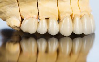 セラミック歯の寿命とダメにしてしまう原因・対策