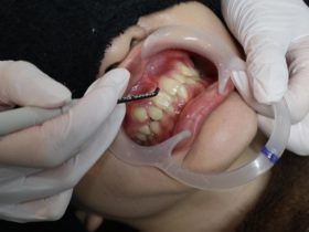 歯肉整形(歯肉形成)とは？歯肉切除のデメリットとメリット