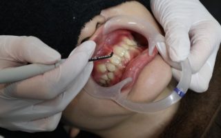 歯肉整形(歯肉形成)とは？歯肉切除のデメリットとメリット
