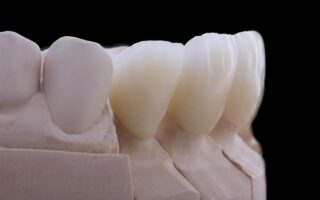 銀歯をセラミックに交換する費用と治療の流れ