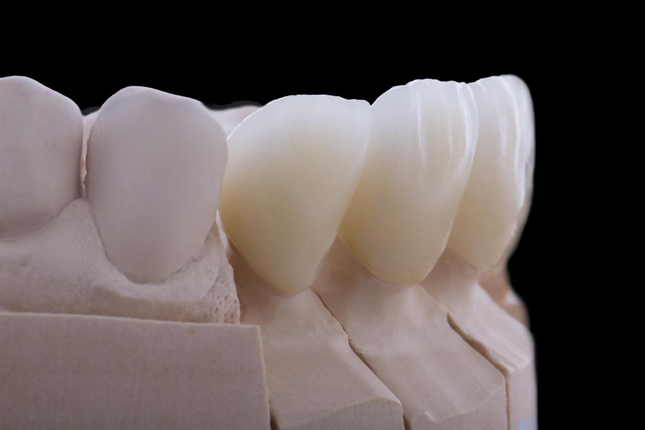 銀歯をセラミックに交換する費用と治療の流れ