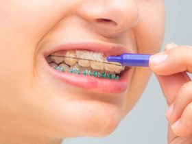 矯正治療中の歯磨きのやり方とおすすめのアイテムも紹介