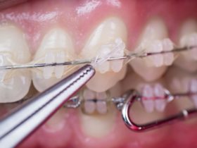 歯列矯正で歯が痛い理由と痛みを抑える対処法