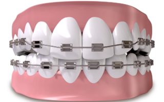 歯列矯正で歯が動く仕組みは？