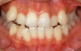 叢生・乱杭歯の原因と矯正治療