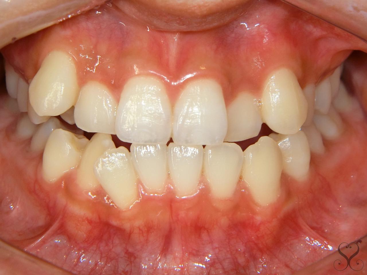 叢生・乱杭歯の原因と矯正治療