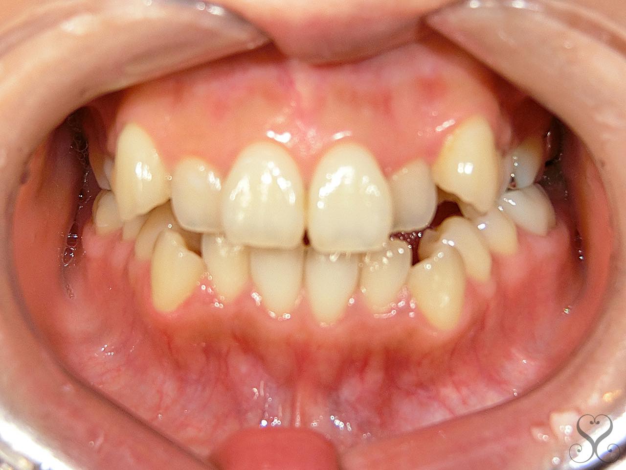出っ歯と八重歯におすすめの歯科矯正は 美歯ラボ いい歯医者