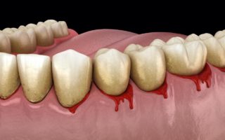 歯周病の原因と症状とは？治療法と予防法も解説