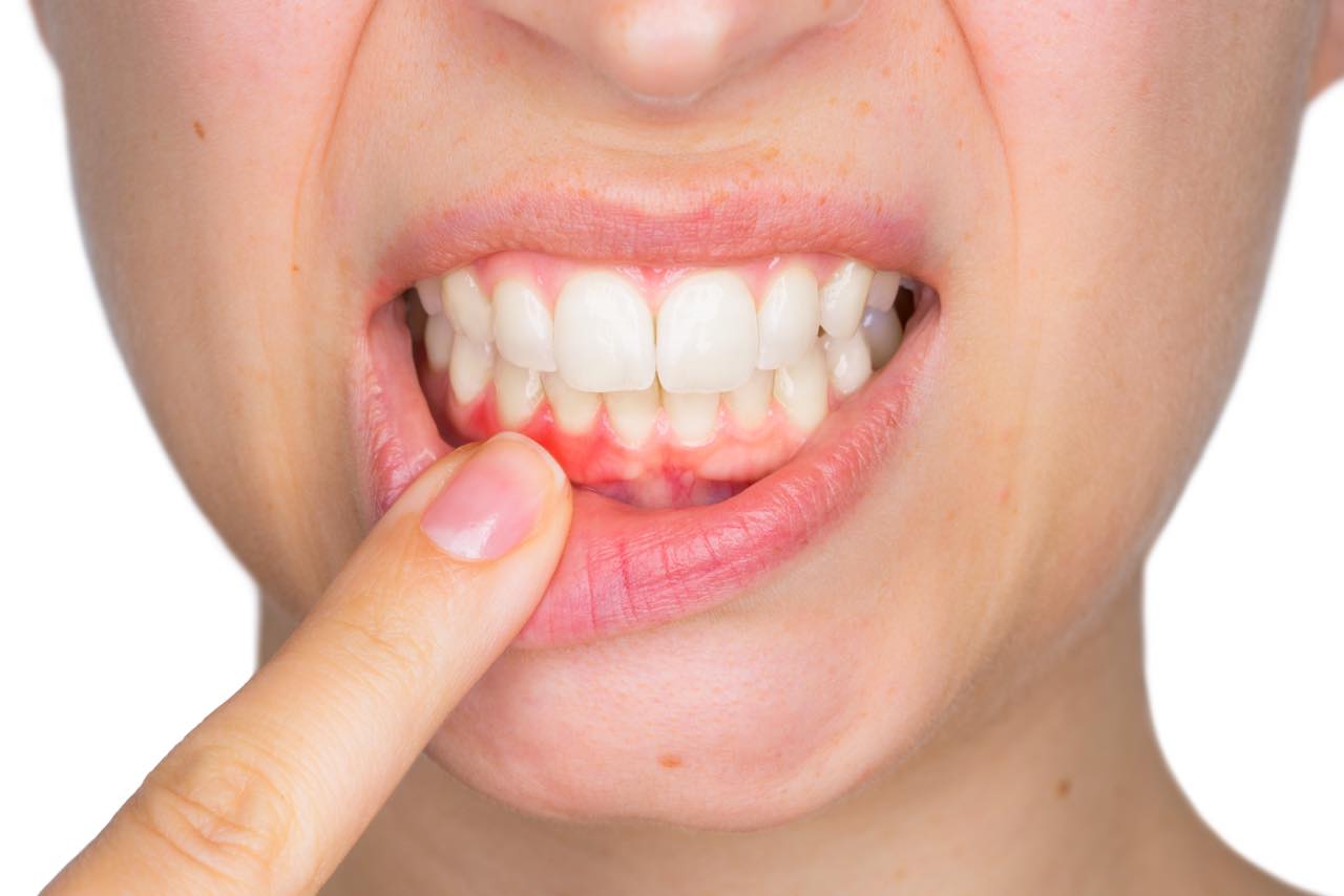 ペリソルブとは？従来の歯周病治療との違いやメリットとデメリット