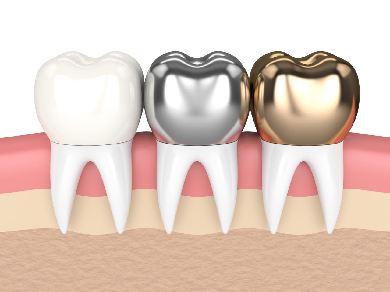 保険と保険外の差し歯の値段と種類 美歯ラボ いい歯医者