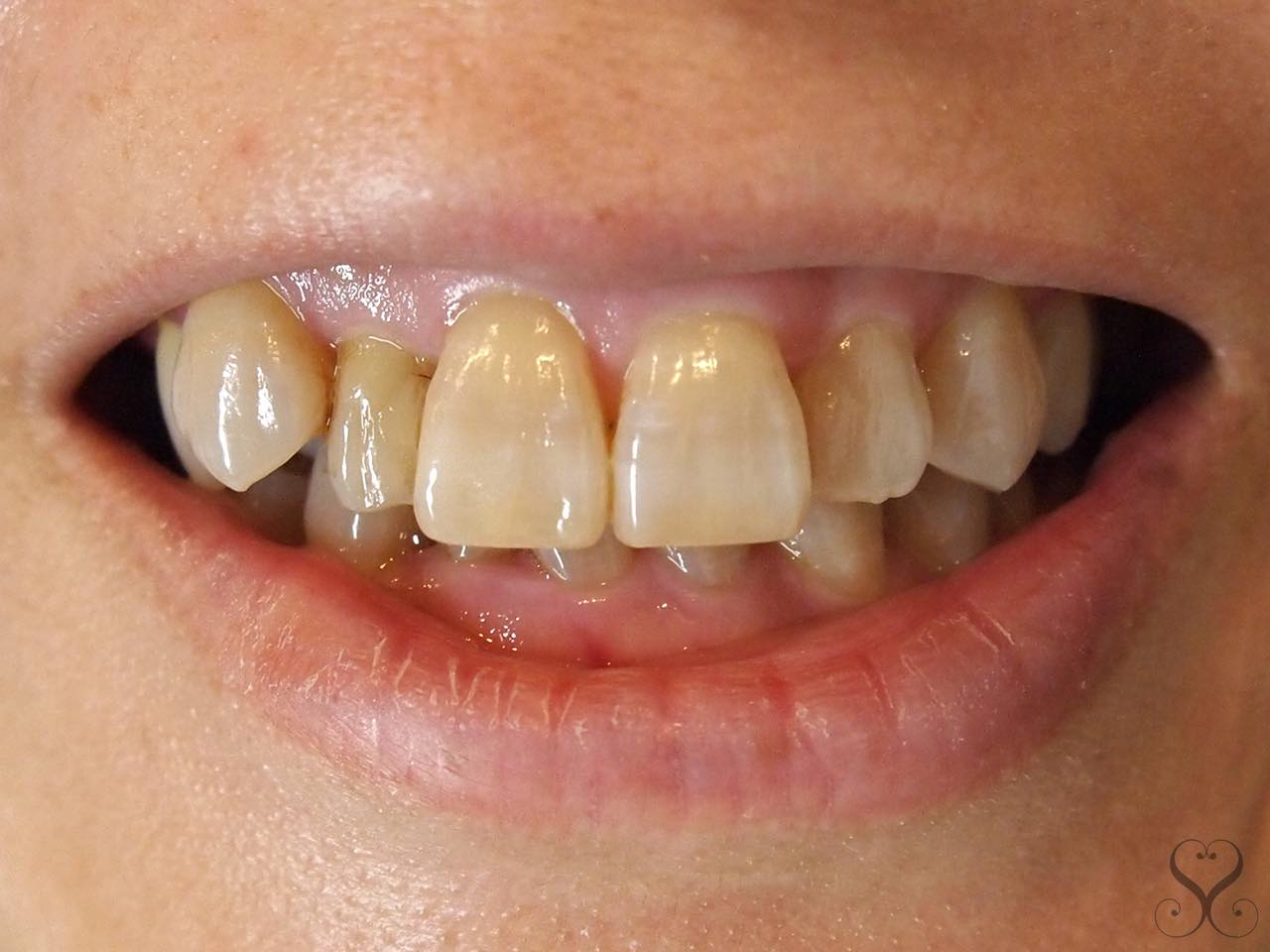 テトラサイクリン歯とは その原因と治療法 美歯ラボ いい歯医者