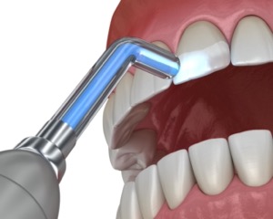 ダイレクトボンディング　テトラサイクリン歯