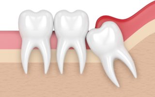歯並び悪化の原因と親知らずの関係について
