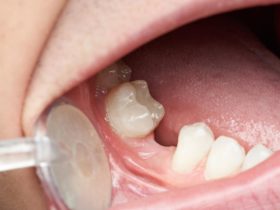 歯がない場合の治療法と原因・症状