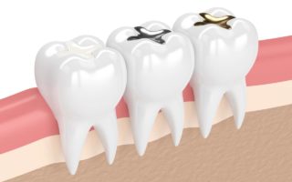 セラミックの歯が取れた場合の対処法とよくある原因