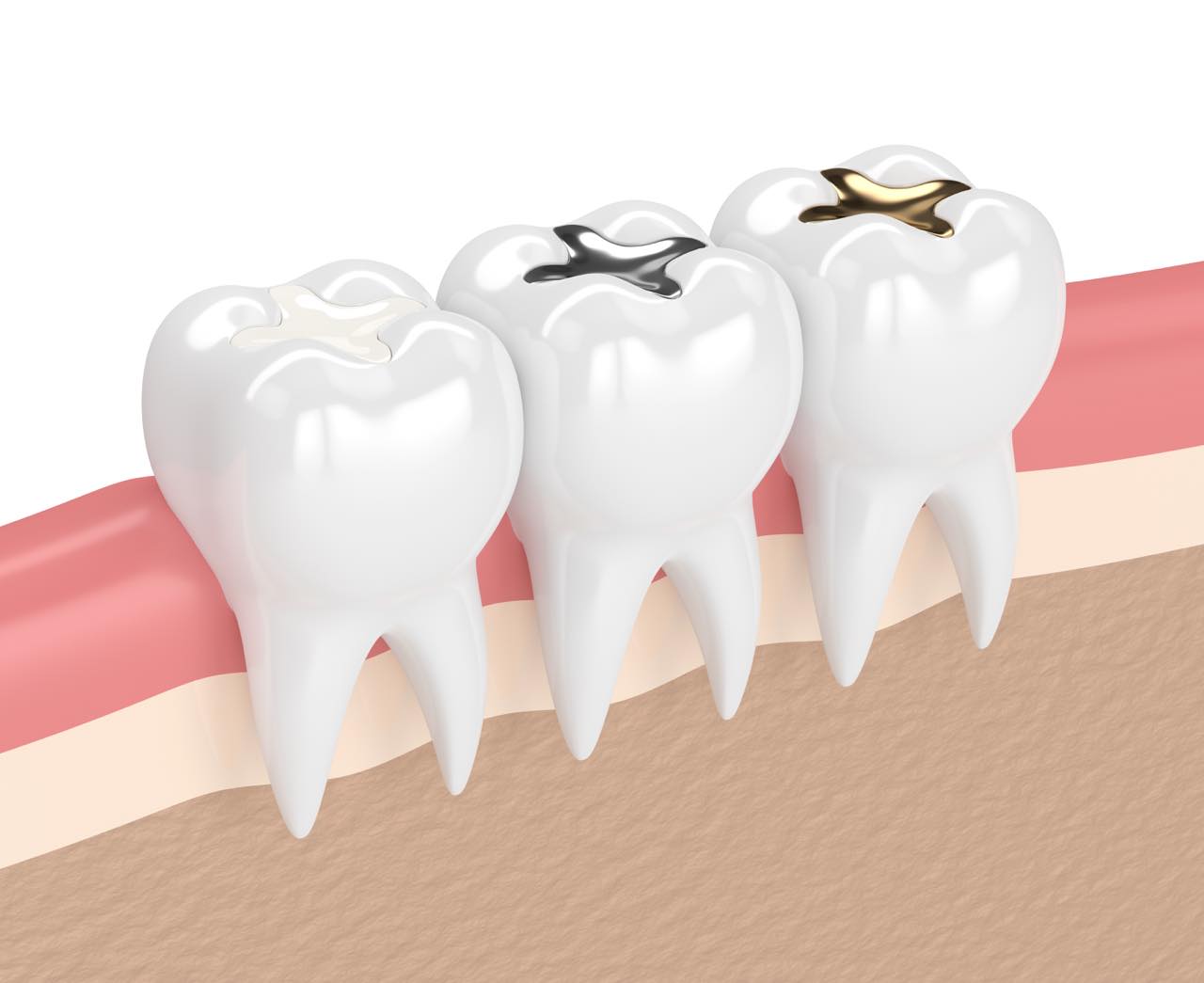 セラミックの歯が取れた場合の対処法とよくある原因