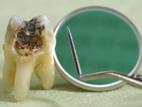虫歯ができる3つ原因と意外な要因も解説