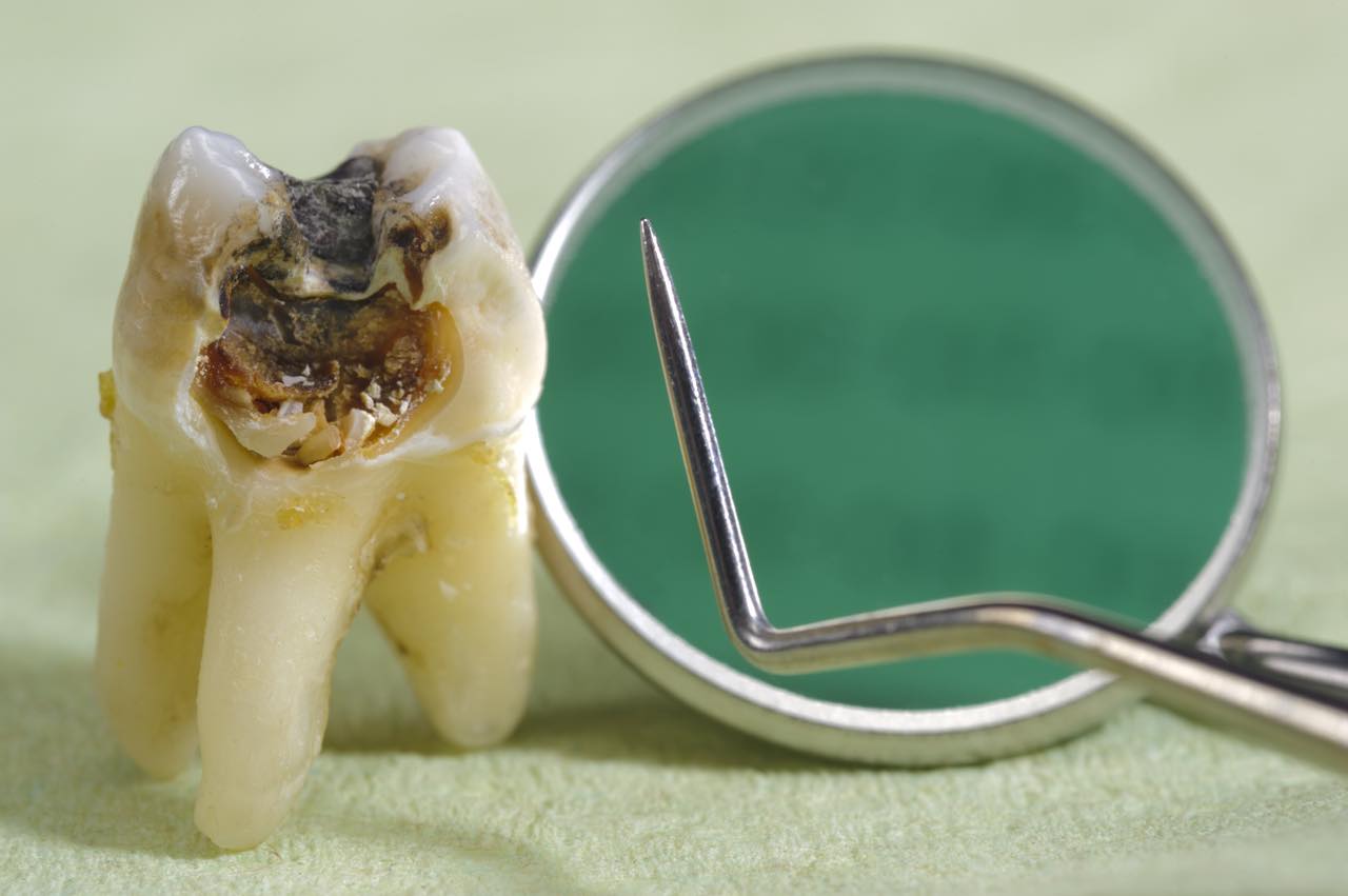 虫歯ができる3つ原因と意外な要因も解説