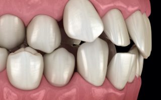 歯並びが悪い原因と種類別の影響と矯正法