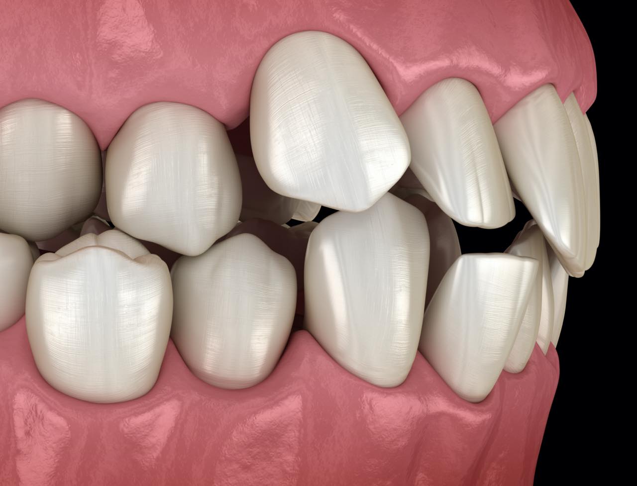 歯並びが悪い原因と種類別の影響と矯正法