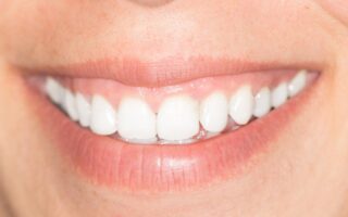 マウスピース矯正でガミースマイルは改善できるの？