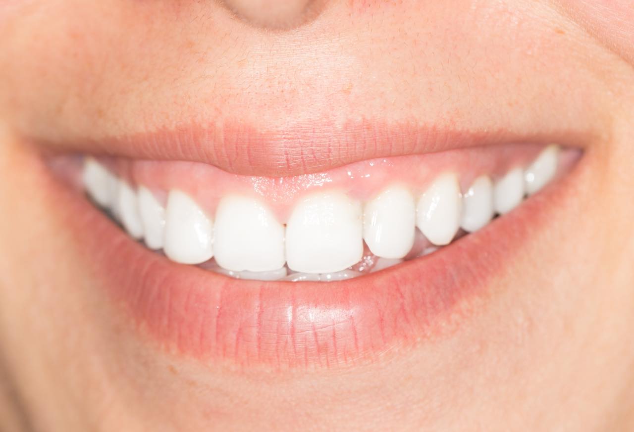 マウスピース矯正でガミースマイルは改善できるの？