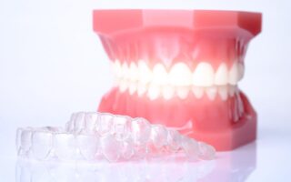 マウスピース矯正をしながらホワイトニングはできるの？