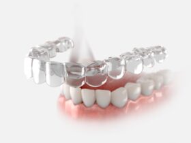 大人の受け口はマウスピース矯正で改善できるの？他の治療法も解説