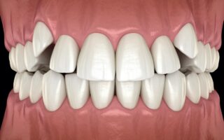 八重歯はマウスピース矯正で治せるの？