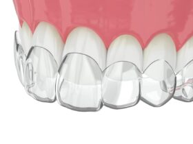 前歯の出っ歯はマウスピース矯正で治せる？