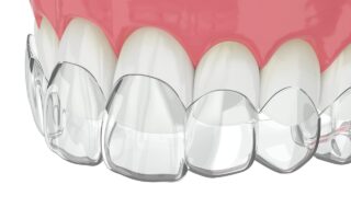 前歯の出っ歯はマウスピース矯正で治せる？