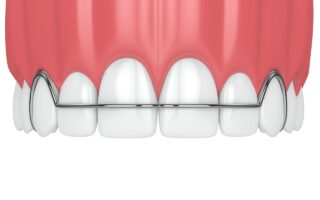 リテーナーを使った歯の矯正後の後戻り防止のための保定期間と装置の種類