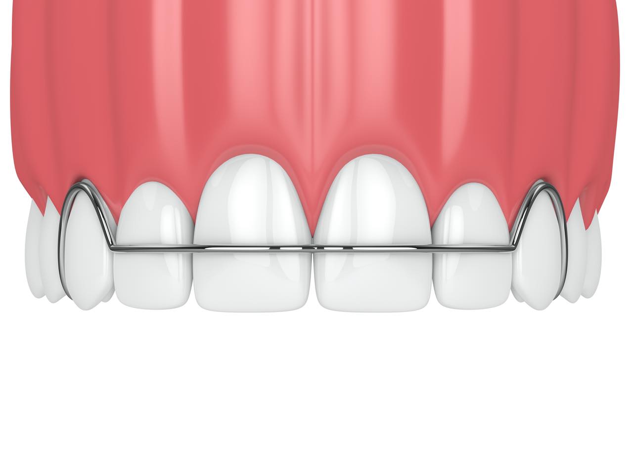 リテーナーを使った歯の矯正後の後戻り防止のための保定期間と装置の種類